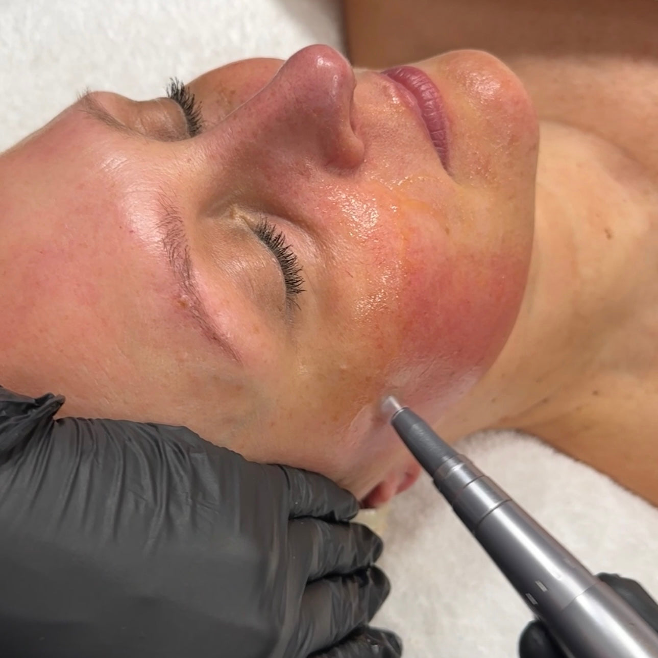 Mikroneulaus-sarjahoito